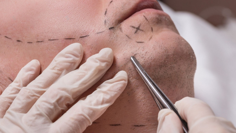 Implante de Barba Antes y Después: Qué Esperar