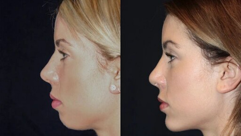 Best Aesthetic Clinics in dubai for Chin Fillers: Sculpt Your Ideal Chin