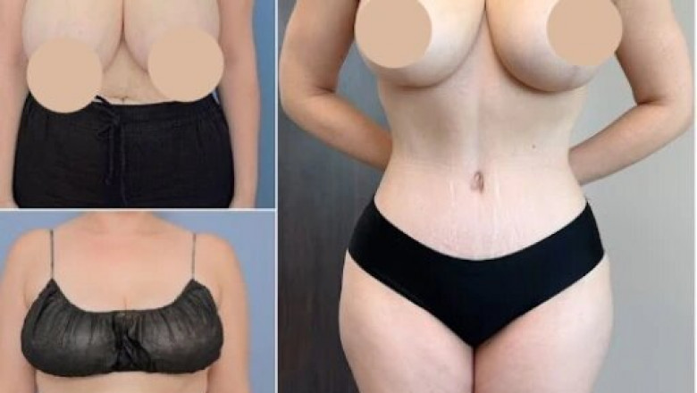 Can Body Contouring in Dubai Improve Your Appearance? Learn How