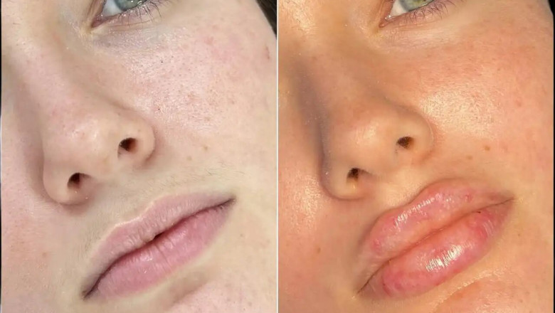 Best Aesthetic Clinics in dubai for Fillers: Achieve a Youthful Appearance