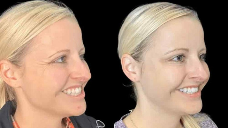 Everything You Need to Know About Botox in Dubai