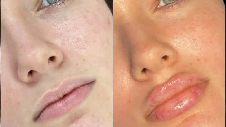 Fillers in Dubai: Ideal Treatments for Every Age