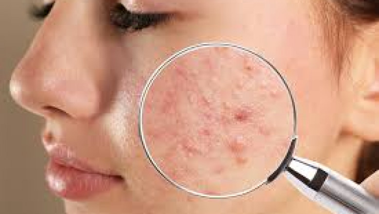 Prescription vs. OTC: Competitive Landscape in the Acne Treatment Market (2025–2035)