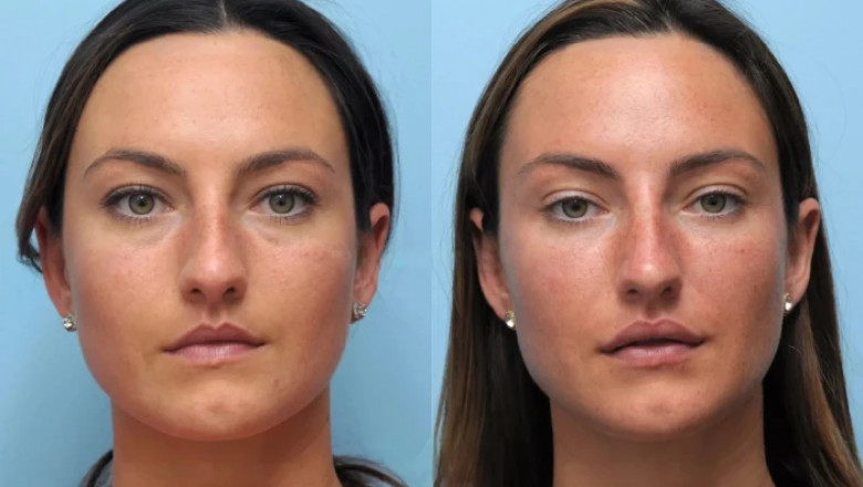 Thread Lift in Dubai A Trend Celebrities Can’t Stop Talking About