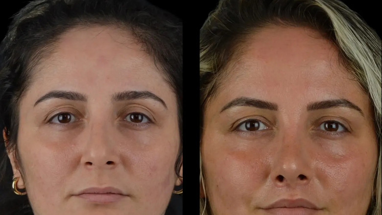 A Guide to Cheek Fillers from the Best Plastic Surgeons in Dubai