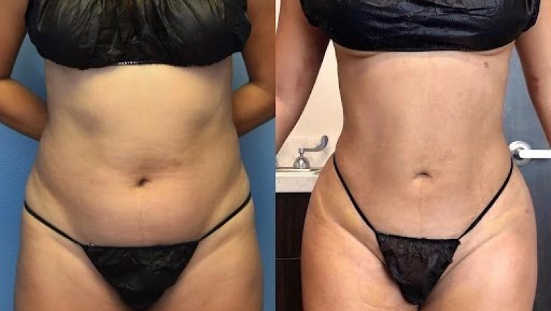 Expert Aftercare Advice for Full Body Liposuction Surgery in Dubai