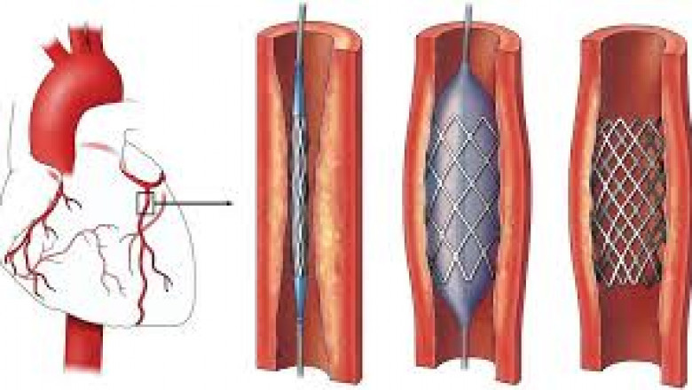 Next-Gen Interventions: The Future of PCI Technologies Through 2034