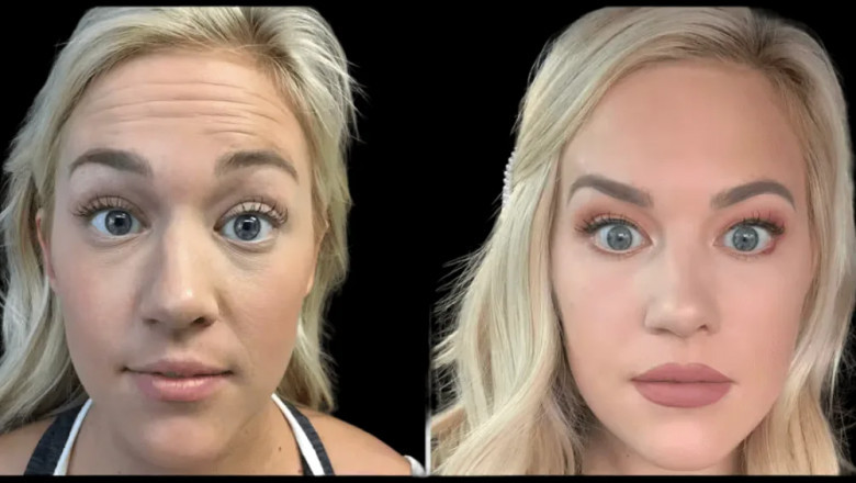 Celebrity Botox Secrets Revealed by the Best Plastic Surgeon in dubai