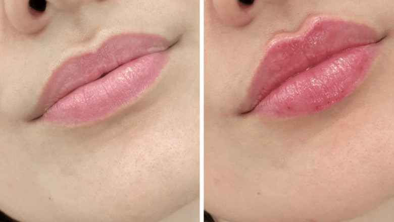 Juvederm for Non-Invasive Face Sculpting: Why the Best Plastic Surgeon in dubai Recommends It