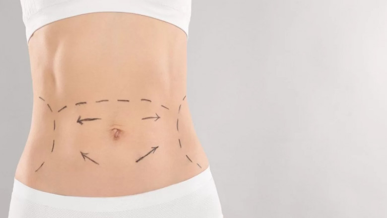 Abdominoplasty Dubai: Sculpt Your Waistline with Expert Tummy Tuck Surgery