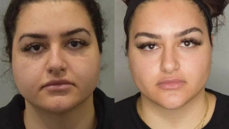 Can Buccal Fat Removal Give a Snatched Look? Best Doctors in Dubai Answer