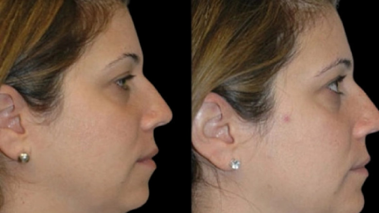Double Chin Removal Recovery Timeline by the Best Doctors in Dubai