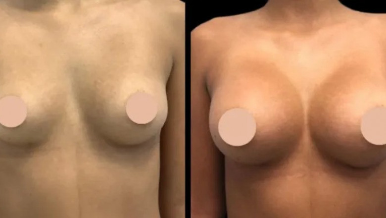 Exploring the Different Surgical Techniques for Breast Augmentation with the Best Doctors in Dubai
