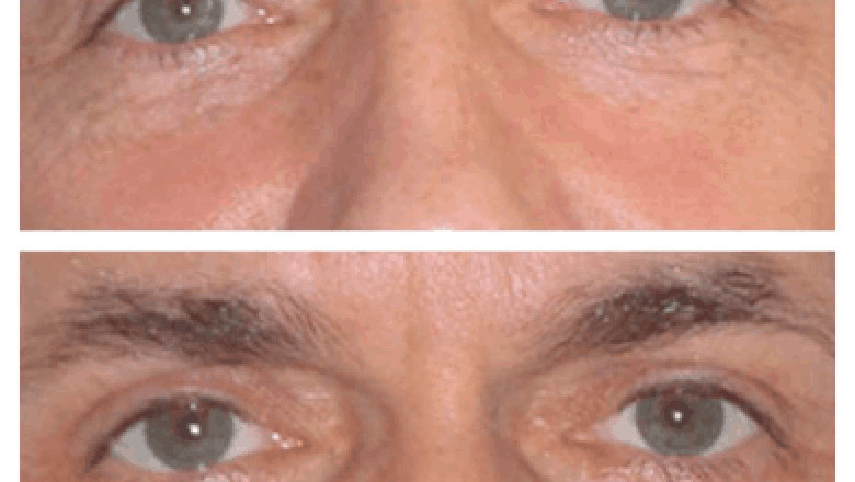 Eye Bag Removal for Men: Advice from the Best Doctors in Dubai