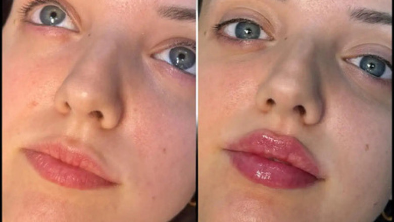 Understanding the Importance of Different Types of Fillers Treatments in Dubai