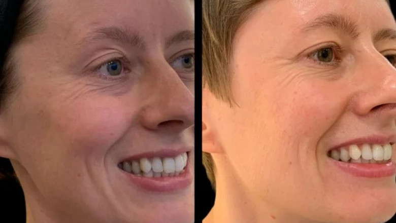 The Benefits of Profhilo: Why the Best Doctors in Dubai Recommend It