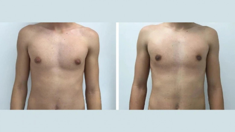 Best Plastic Surgeons for the Gynecomastia Surgery in dubai